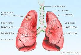 Pin On Mesothelioma