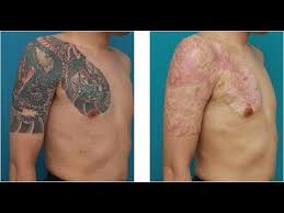 And yes this is considered a tattoo removal method without laser. Remove Tattoos Without Laser Treatment Tattoo Removal Side Effects With Laser Treatment Youtube