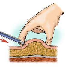 Image result for infermieristica come fare l'iniezione