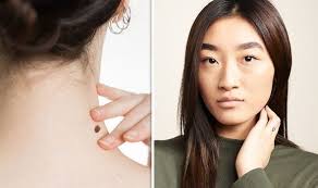 cancers are a little more common as we get into our middle years. Cancer Symptoms How To Identify Skin Cancer When It Is A Squamous Cell Carcinoma Express Co Uk