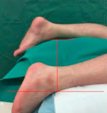 A lot of confusion exists between these two different entities, i hope this video will explain things clearly! Haglund S Deformity And Chronic Achilles Tendonitis Sciencedirect