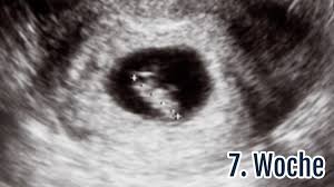 Ssw) beginnt die entwicklung des gesichts (bild bei 7+4). 7 Ssw Die 7 Schwangerschaftswoche Anzeichen Ultraschall Tipps Netmoms De