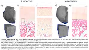 We did not find results for: Maturation Of The Medial Femoral Condyle Epiphyseal Growth Plate And Osteochondral Junction Osteoarthritis And Cartilage