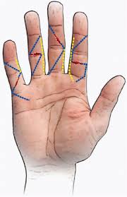 Flexor tendon repair flexor tendons are repaired with a combination of core sutures and epitendinous sutures.3 it has been advocated that at least four core strands should be placed to enable early active motion. Zone Ii Flexor Tendon Repair Musculoskeletal Key