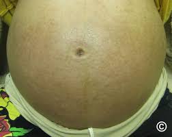 Image result for pruritic urticarial papules and plaques of pregnancy