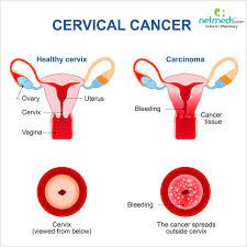 Pain may be intermittent or constant and is typically worse during or after intercourse. Cervical Cancer Causes Symptoms And Treatment Netmeds