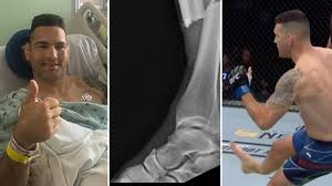 With a full capacity of fans returning at the vystar veterans memorial arena in jacksonville, florida, for the first time since the pandemic, the crowd bore. Ufc Fighter Chris Weidman Posts Horrific Pre Surgery X Ray Images Of Double Leg Break Suffered