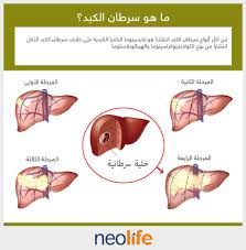 معظم سرطانات البروستاتة غالبًا ما تكون بطيئة النمو، غير أن هناك بعض الحالات التي تتميز بكونها أكثر شراسة وخطورة. Ø§Ù„ÙƒØ¨Ø¯ Ø¹Ø¶Ùˆ Ø¨Ø­Ø¬Ù… ÙƒØ±Ø© Ø§Ù„Ù‚Ø¯Ù… ÙŠØ³ØªÙ‚Ø± ÙÙŠ Ø§Ù„Ø¬Ø²Ø¡ Ø§Ù„Ø¹Ù„ÙˆÙŠ Ø§Ù„Ø£ÙŠÙ…Ù† Ù…Ù† Ø§Ù„Ø¨Ø·Ù† Ø£Ø³ÙÙ„ Ø§Ù„Ø­ Ø¬Ø§Ø¨ Ø§Ù„Ø­Ø§Ø¬Ø² ÙˆÙÙˆÙ‚ Ø§Ù„Ù…Ø¹Ø¯Ø©