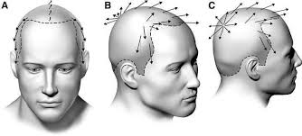 Best hair transplant reviews 2020. Natural Hair Transplant And Hairline Dr Hakan Doganay