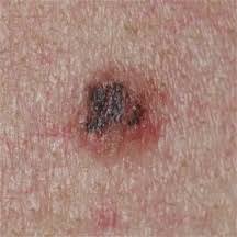 Il faut noter qu'un grain qui gratte ou démange n'est pas systématiquement un cancer. Grain De Beaute Et Naevus Nevus Dr Abimelec