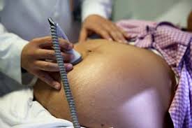 Resultado de imagem para ONU defende direito ao aborto em países atingidos pelo Zika Vírus