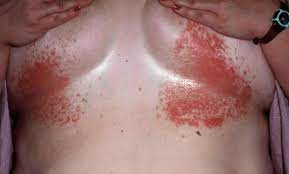 It has a tendency to change and often worsen through the. Intertrigo Causes Symptoms Diagnosis And Intertrigo Treatment