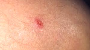 The bite causes only mild local effects and is painful but only for short duration and pain does not lasts for long. White Tailed Spider Readers Tell Us What Happened When A White Tail Spider Bit Them