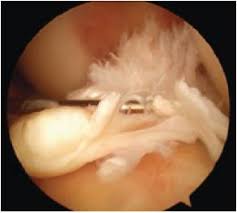 ACL FAQs | Knee | Doctor Articles | Asia Medical Specialists