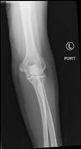 Image result for Elbow XRay