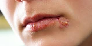 Herpes Im Mund Ausloser Und Behandlung Heilpraxis