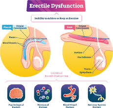 الضعف الجنسي وامراض الذكورة