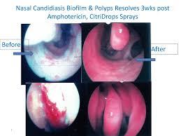 10 best nasal sprays of june 2021. Marcons Is A Ubiquitous Sinus Infection Worth Treating Mold Free Living