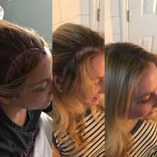 A brain aneurysm can leak or rupture, causing bleeding into the brain (hemorrhagic stroke). Am S Brain Surgery Rob Anne Marie