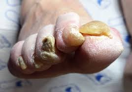 Check spelling or type a new query. Thick Bendy Toenails Potty Purple Pod