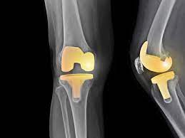 Extending the life of your knee implant. Knee Replacement Surgery Overview