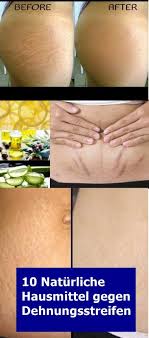 Wenn die schwangerschaftsstreifen/dehnungsstreifen sich doch zeigen, kannst du auch nach der mandelöl, kokosöl und aloe vera können täglich einmassiert die elastizität der haut erhöhen. Dehnungsstreifen