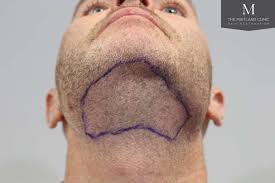Here's the thing when it comes to hair loss, every single person with androgenic hormones in their body is going to be prone to hair loss, the level of. Body Hair Transplant Alliance4hair Com