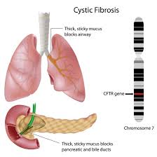 Cystic fibrosis (cf) is the most common lethal inherited disease in white persons. Cystic Fibrosis Epidemiology