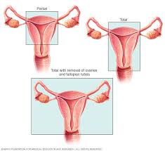 Cervical stump cancer management of cervical stump cancer follows the recommendations. Abdominal Hysterectomy Mayo Clinic