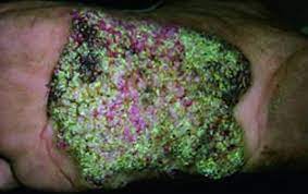 Tuberculosis verrucosa cutis (tbvc) was once seen in 65.5% of the childhood cases from hong kong, it is an uncommon form of the disease in indian introduction: Image Cutaneous Tuberculosis Verrucosa Cutis Msd Manual Professional Edition