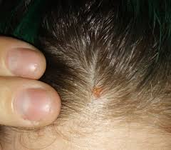 Image result for dry scabs on the head in children
