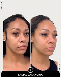 BALANCED BEAUTY ✨📐 @injectionsbyhelen Helen masterfully achieved this  harmonious facial balance for her patient. This comprehensive approach  involved strategically placed: ▪️ Chin filler to enhance projection and  definition. ▪️ Chin shadowing to