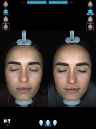 ✨ Just 2 weeks difference, using the right medical grade routine! These  before & after skin analysis images show how quickly the skin can change  when inflammation is properly treated. What you're