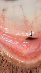 Image result for Conjunctival Foreign Body