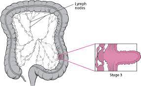Colon cancer is a type of cancer that originates in the cells lining the large intestine. Colorectal Cancer Digestive Disorders Merck Manuals Consumer Version