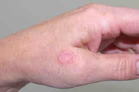 They are not accompanied by rheumatoid factors or bone erosions, but are associated with concomitant joint diseases. Granuloma Annulare Granuloma Annulare For More Informatio Flickr