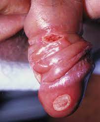 Check spelling or type a new query. Syfilis Find Information Pa Medicin Dk