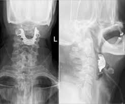 The stage of throat cancer is characterized with the roman numerals i through iv. Laryngeal Cancer Latest News And Research Updates