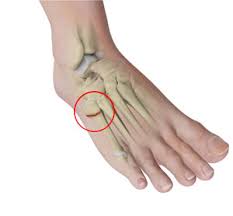 Image result for Metatarsal