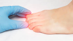 Image result for mykoza nehtů