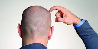 To put this into perspective, hair loss was reported more frequently than nausea or vomiting, tachycardia (a fast. Weight Loss And Hair Loss Does Losing Weight Make You Go Bald The Bald Gent