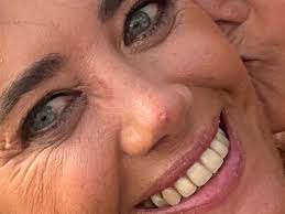 Image result for skin cancer on nose pimple