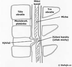 Image result for vyhřezlá ploténka