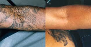 Laser tattoo removal, san francisco. Laser Tattoo Removal Walnut Creek Revlite Laser Brentwood Livermore