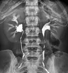 Image result for Intravenous Pyelogram