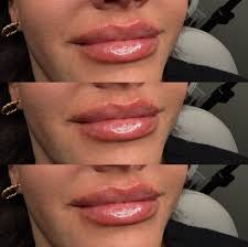 𝐋𝐢𝐩 𝐟𝐢𝐥𝐥𝐞𝐫 𝐭𝐫𝐚𝐧𝐬𝐟𝐨𝐫𝐦𝐚𝐭𝐢𝐨𝐧