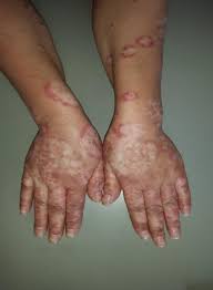El vitiligo se presenta cuando las células inmunitarias destruyen las células que producen el pigmento de color café (melanocitos). Psoriasis And Vitiligo Are Close Relatives Ccid