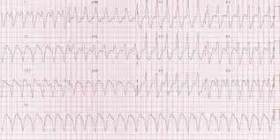 Vtach and vfib (ventricular tachycardia and fibrillation). Ventricular Tachycardia Monomorphic Vt Litfl Ecg Library