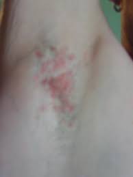 Ausschlag Unter Den Armen Achseln Seit Zwei Wochen Bepanthen Und Zinksalbe Sind Nicht Hilfreich Was Kann Ich Noch Tun Gesundheit Dermatologie Hautausschlag