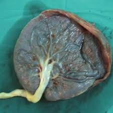 I was just told that i have a marginal cord insertion, meaning the cord isn't attached to the middle of the placenta, rather on the edge? 1 Central Cord Insertion 2 Marginal Cord Insertion Download Scientific Diagram